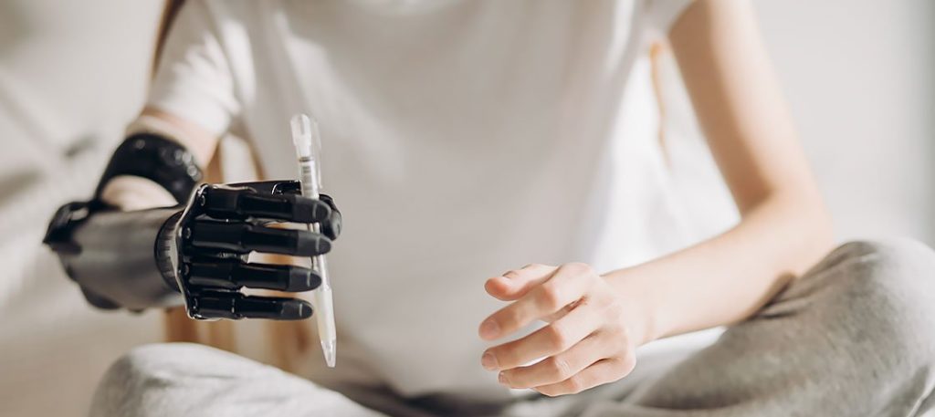 Medical 3d printed prosthetic arm